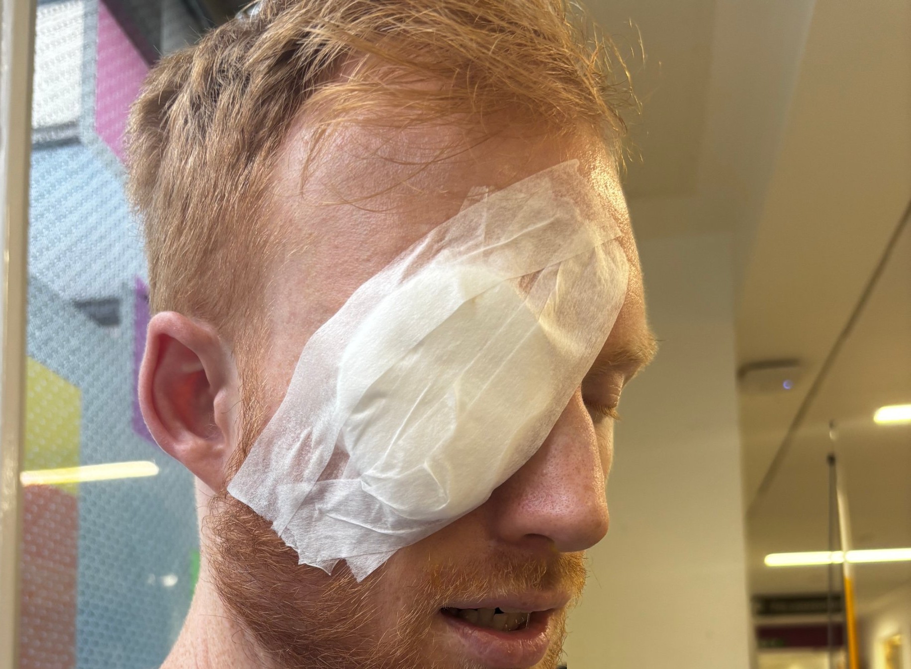 Louis Jarrold with a dressing taped over one eye after his injury